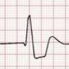 ECG K