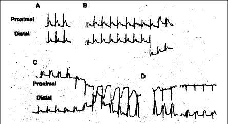 Patrón Penetración MP